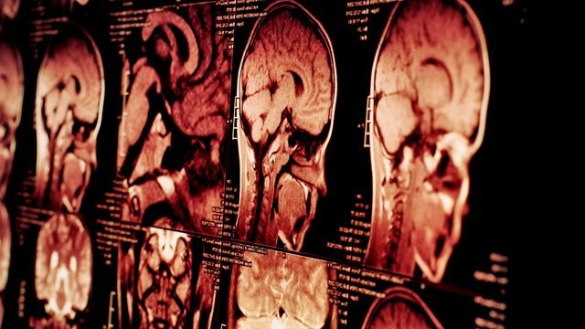 Study identifies shared brain circuits in insomnia, anxiety, depression